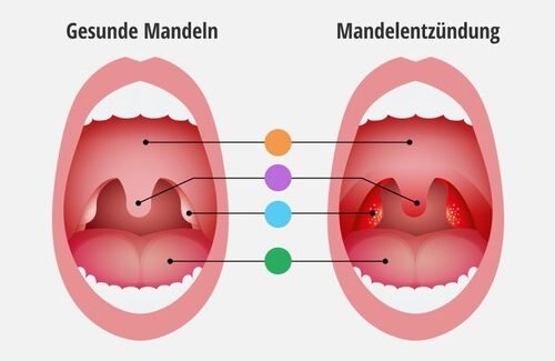 Starke Halsschmerzen